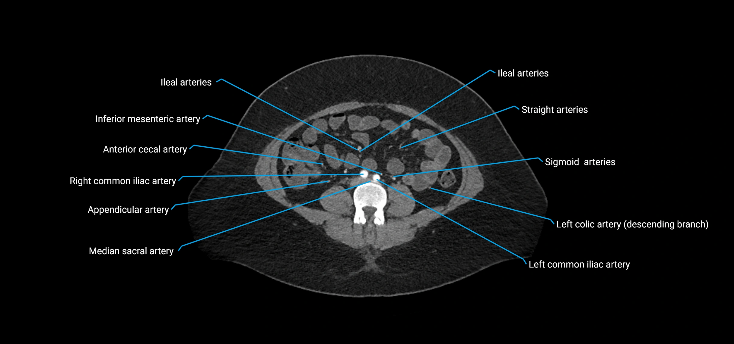CTA abdomen axial cross sectional anatomy labelled image_135 (2).webp